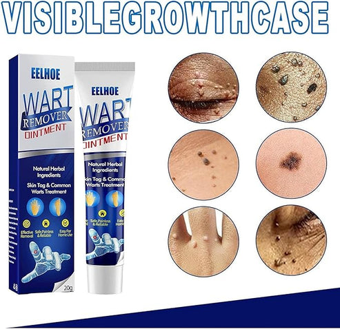 Wart Remover Instant Blemish Removal Cream šāØ
